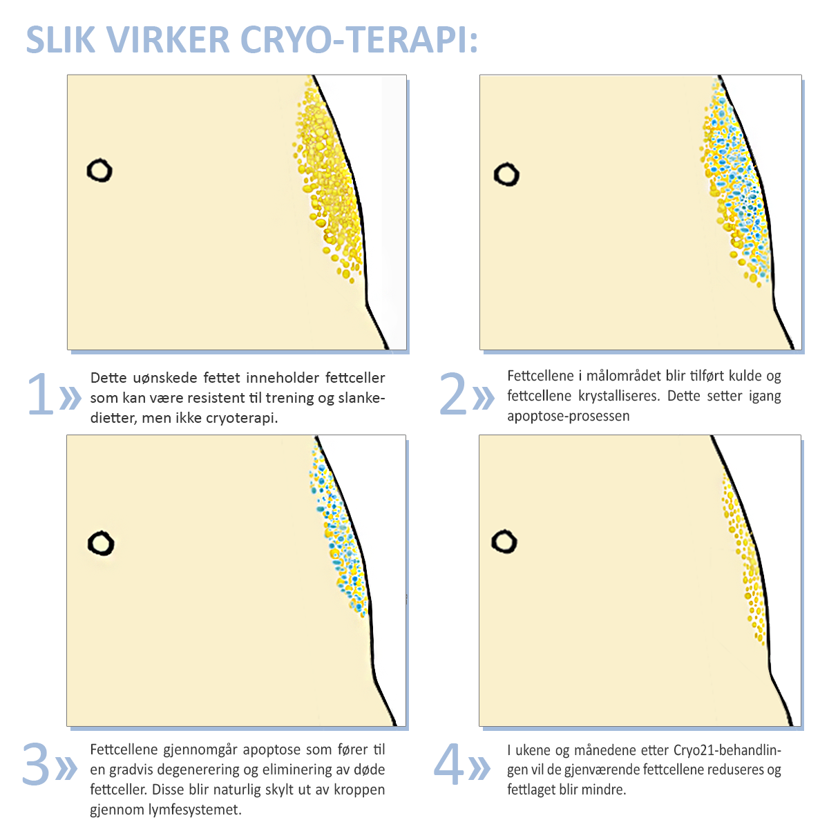 Bilde av hvordan Cryo-terapi fungerer